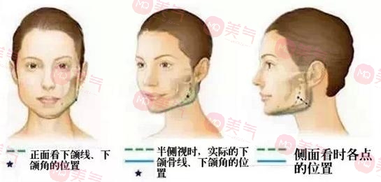 北京八大處頜面外科哪個大夫好？張智勇醫(yī)生-下頜角案例圖反饋