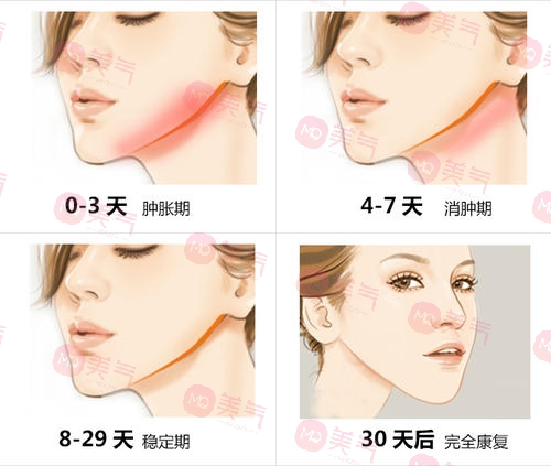 北京八大處頜面外科哪個大夫好？張智勇醫(yī)生-下頜角案例圖反饋