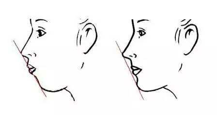 凸嘴改善介紹,效果、價(jià)格和優(yōu)缺點(diǎn)是什么？