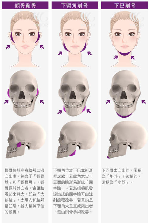 下顎前凸項目介紹,價格是多少？附案例展示
