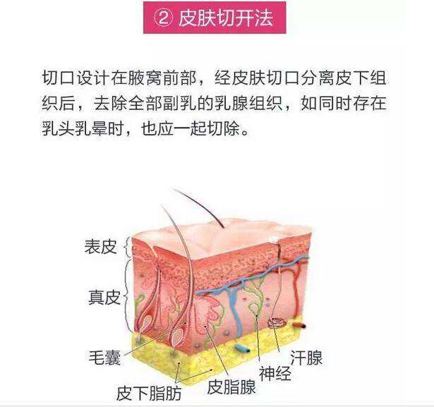 吸脂去副乳要多少錢？效果好不好？項目介紹和優(yōu)缺點盤點
