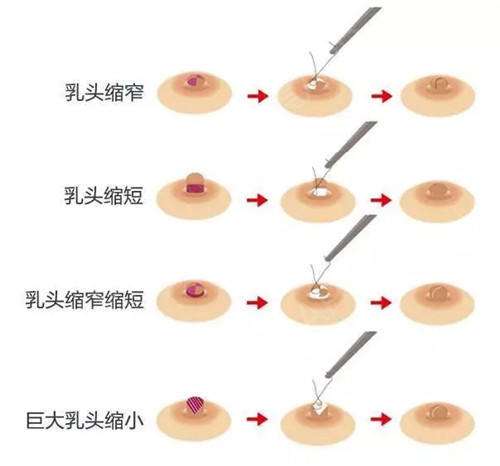 乳房縮小多少錢？效果怎么樣？簡介和優(yōu)缺點(diǎn)盤點(diǎn)