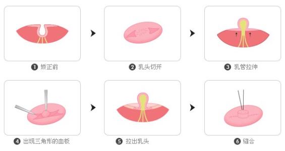乳頭凹陷矯正多少錢(qián)？效果怎么樣？簡(jiǎn)介和優(yōu)缺點(diǎn)盤(pán)點(diǎn)