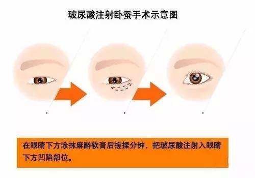 玻尿酸填臥蠶效果好不好？要多少錢？項(xiàng)目介紹和優(yōu)缺點(diǎn)盤(pán)點(diǎn)