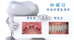 全口種植牙恢復(fù)期是多久?項(xiàng)目簡(jiǎn)介_真實(shí)案例_優(yōu)缺點(diǎn)介紹
