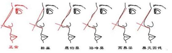 鷹鉤鼻矯正要多少錢？項目介紹和案例展示