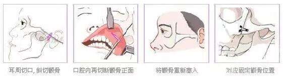 顴弓降低項(xiàng)目介紹,價(jià)格是多少？附案例展示