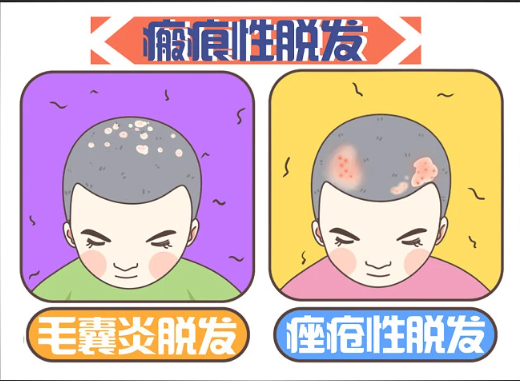 廣州倍生植發(fā)醫(yī)院技術(shù)如何？選對醫(yī)院不再為禿頭煩惱！