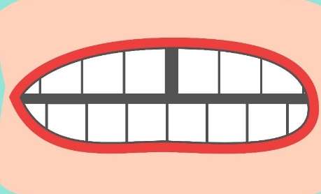 牙縫大了怎么補(bǔ)救？常見的修復(fù)方式就是貼面修復(fù)，正畸矯正，牙冠修復(fù)等
