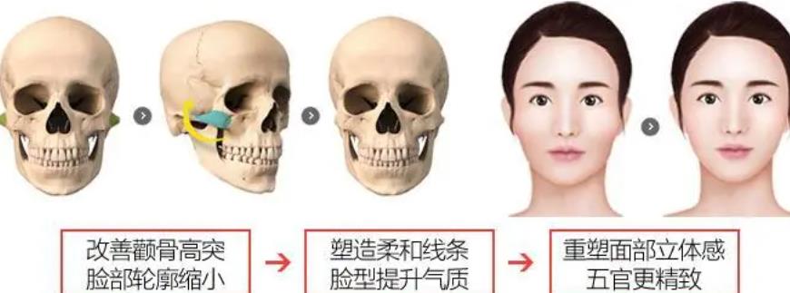 顴骨內(nèi)推動漫4.jpg