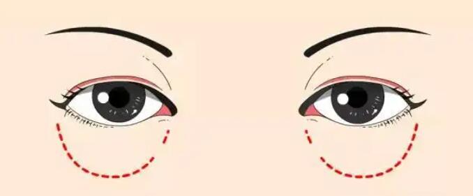 去眼袋動漫26.jpg
