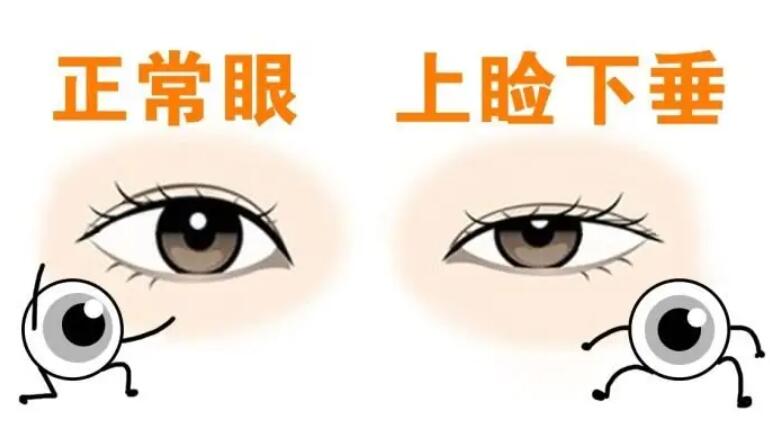 上瞼下垂矯正02.jpg