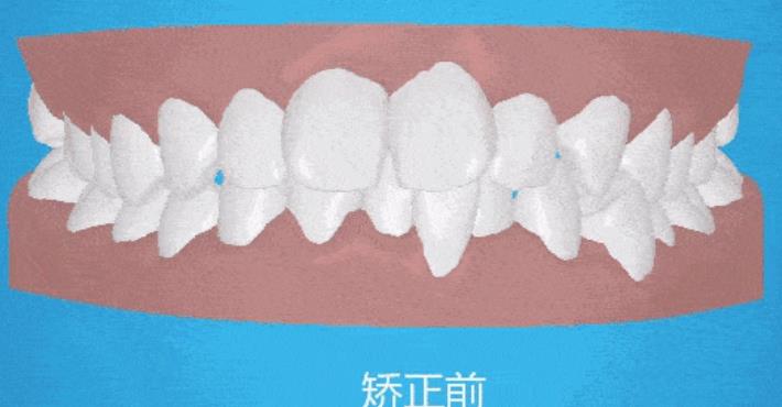 牙齒矯正hg20.jpg