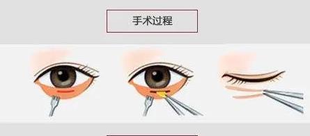 抽脂去眼袋.jpg