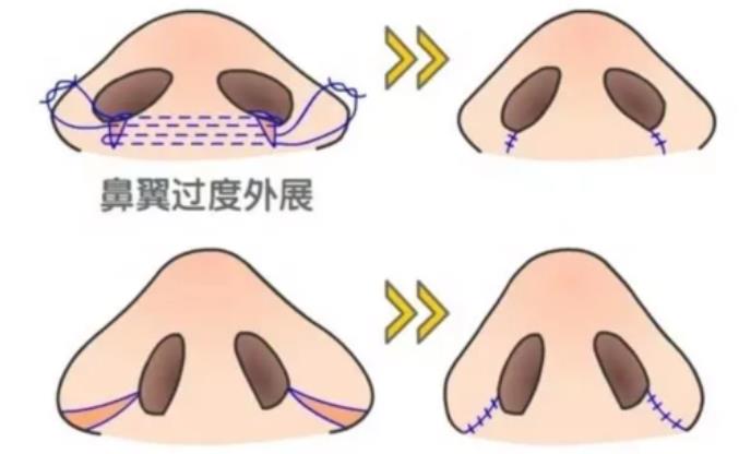 鼻頭肥大動漫01.jpg