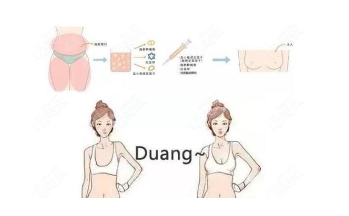 脂肪隆胸.jpg