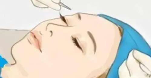 雙眼皮