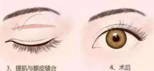 雙眼皮