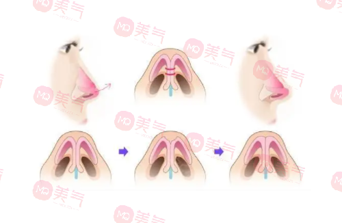 自體肋骨隆鼻的危害有哪些？手術(shù)風(fēng)險(xiǎn)、疼痛和腫脹…
