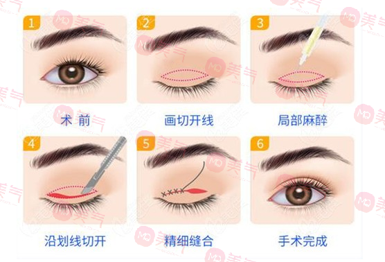 上海九院雙眼皮哪個醫(yī)生比較好？