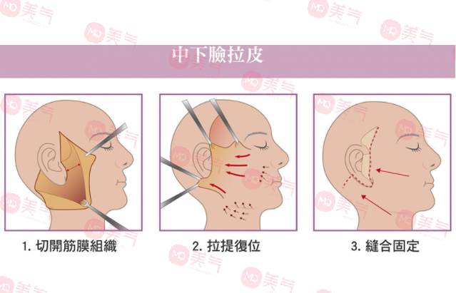 上海九院拉皮手術哪個醫(yī)生做的好？