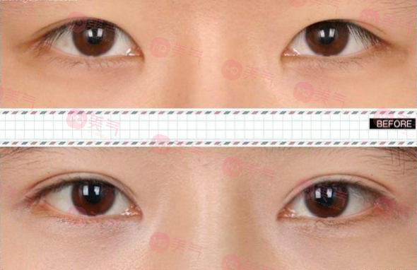 北京八大處整形雙眼皮多少錢(qián)？