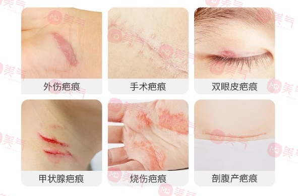北京八大處整容醫(yī)院做疤痕修復(fù)多少錢(qián)？