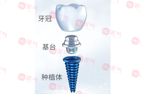 種植牙齒多少錢一顆2023？種植體品牌、醫(yī)生選擇都決定了定價(jià)！