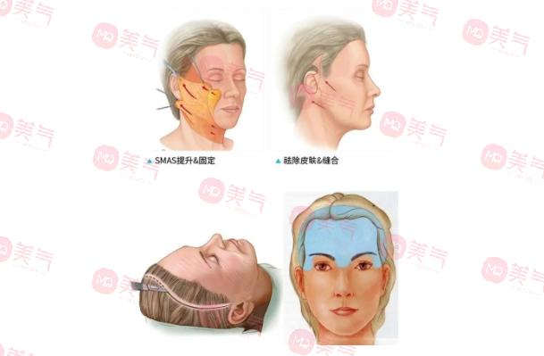 北京煤醫(yī)王馳拉皮手術(shù)多少錢？醫(yī)生技術(shù)介紹+價格表參考