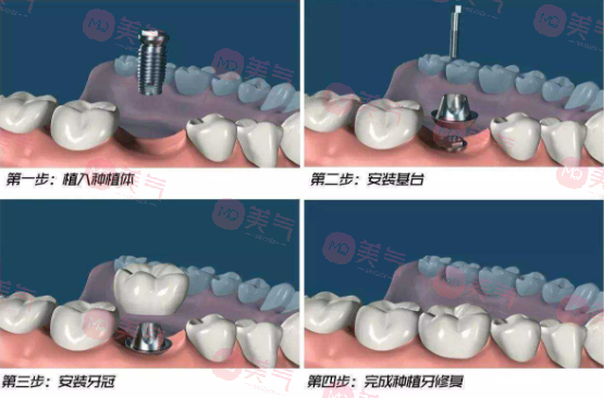 北京種植牙多少錢一顆？?jī)r(jià)格費(fèi)用_注意事項(xiàng)_使用年限