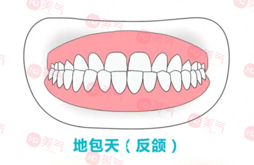 地包天矯正需要多少費(fèi)用？骨性地包天整形費(fèi)用2-4萬(wàn)起