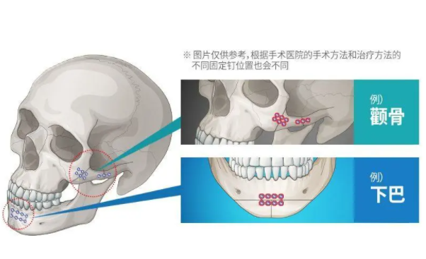 上海李志海和柴崗顴骨顴弓術(shù)手術(shù)費(fèi)用分別是多少？