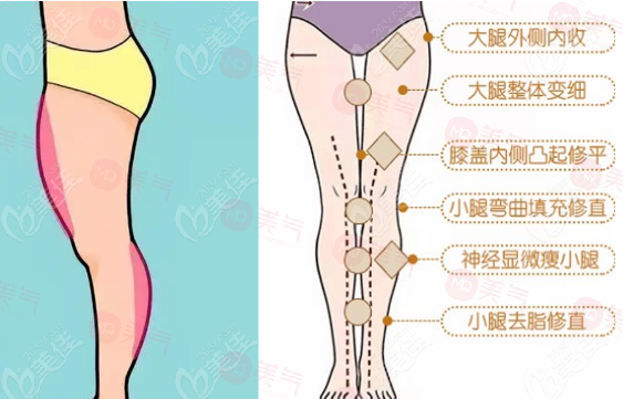 臀部吸脂手術(shù)優(yōu)點、作用、注意事項介紹