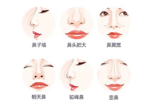 鼻部整形