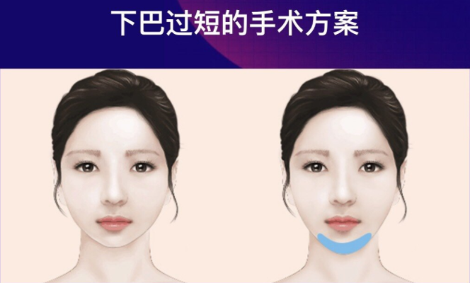 墊下巴