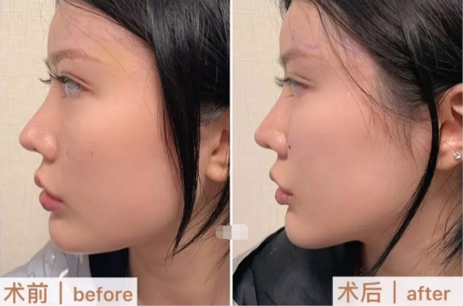 豐蘋果肌