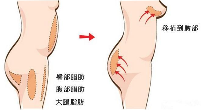 自體脂肪隆胸